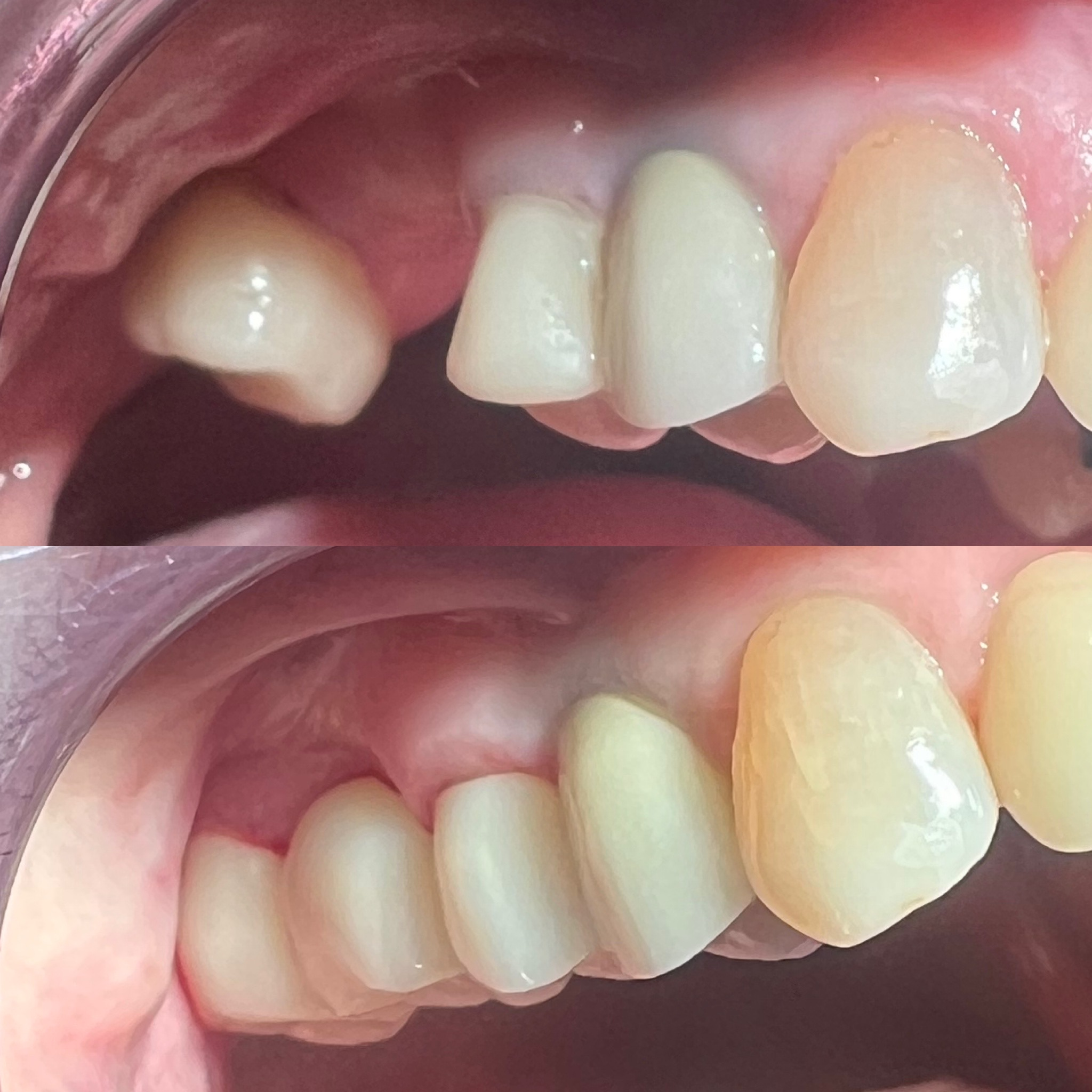 Maxillary Three Unit Zirconia Bridge